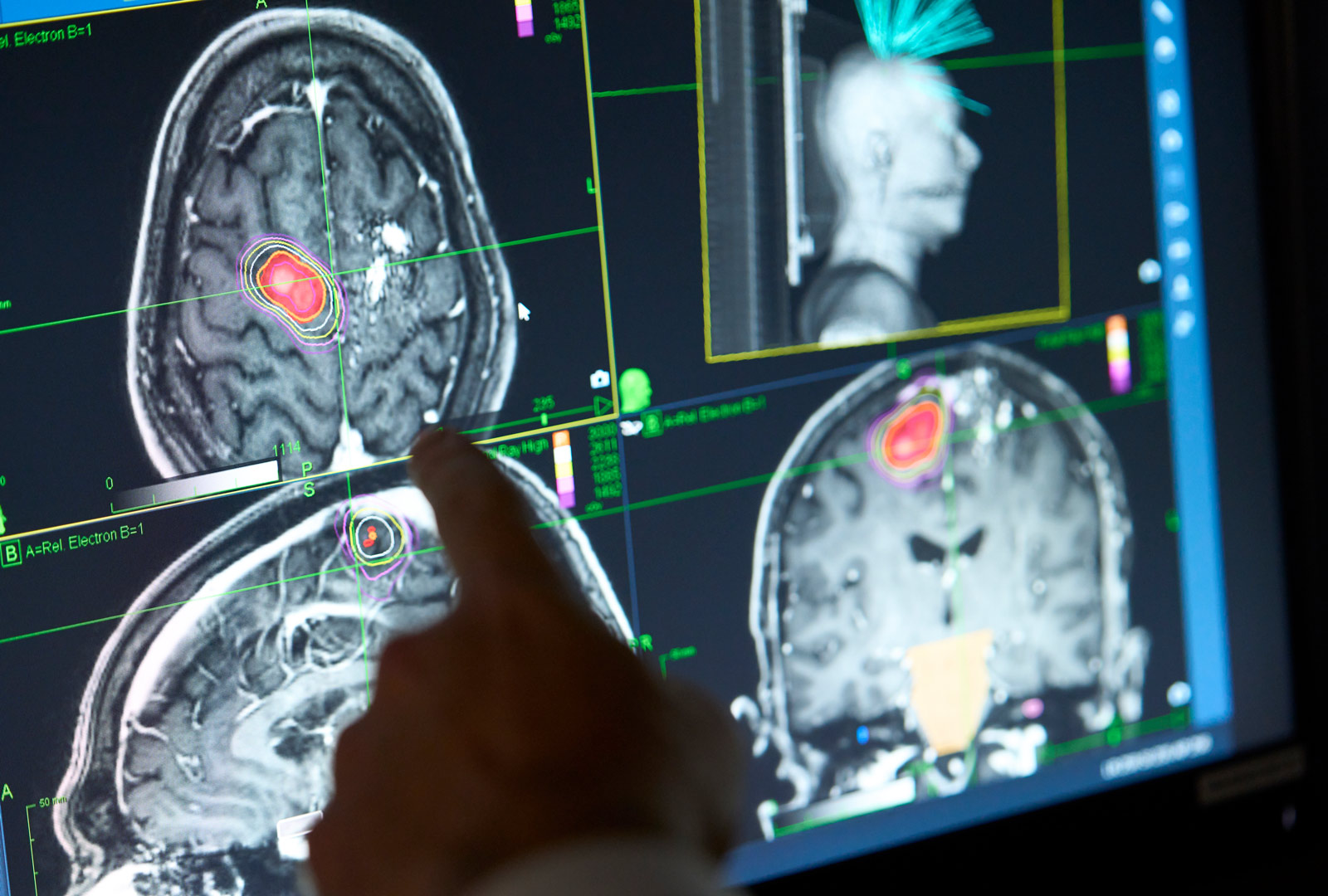 Radiation Oncologist points to brain scans on computer.